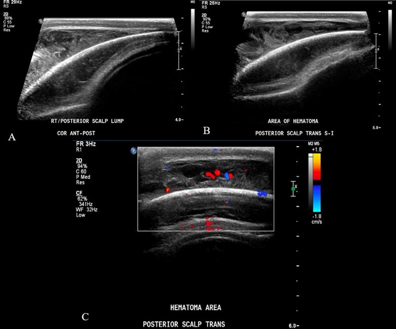  Ultrasound soft tissue head using multiplanar gray scale and color Doppler images. The superficial subcutaneous soft tissue appears homogeneous and uniform thickness. There is a layer of heterogeneous               echogenicity deep to the subcutaneous layer, on the surface of the bone which appears retained by an echogenic capsule or membrane. This measures up to 9 mm greatest thickness. The size of the collection is greater than the transducer can measure. Additional images performed to include the edges of the hemorrhage show uplifting of the galea consistent with subgaleal location. The cranial sutures are not adequately included. 