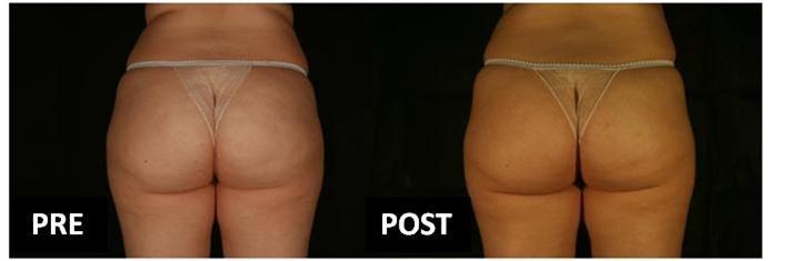 Cellulite clinical aspect in the gluteal region of one participant at baseline and the end of the intervention