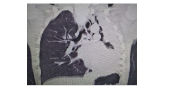 Journal of Preventive Medicine And Care-Plastic bronchitis