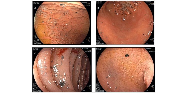 Journal of Clinical Case reports and Images-Malignant Melanoma