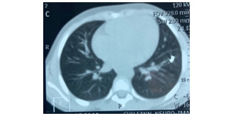 Journal of Clinical Case reports and Images-intrathoracic foreign body