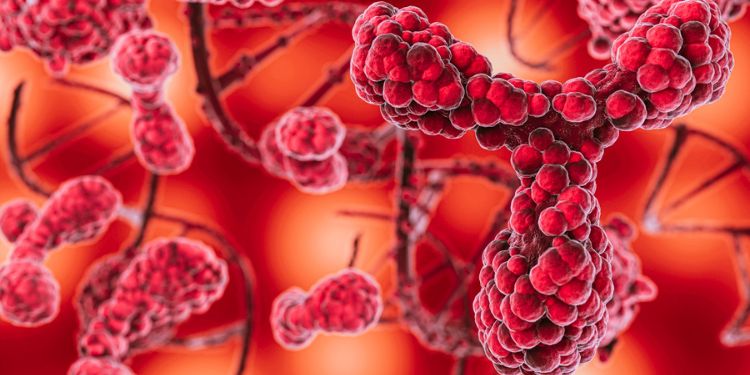 Article: Disseminated Mucormycosis Diagnosed by Urine Microscopy in a Patient with Relapsed Acute Lymphoblastic Leukemia: A Case Report